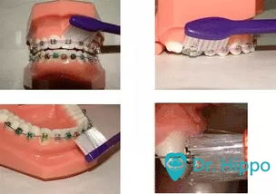 牙套君如何正确清洁牙齿与通用鞋类护理指南
